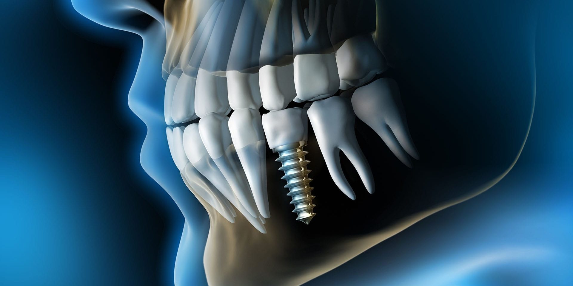 article-blog-implant-dentaire-boulogne-billancourt