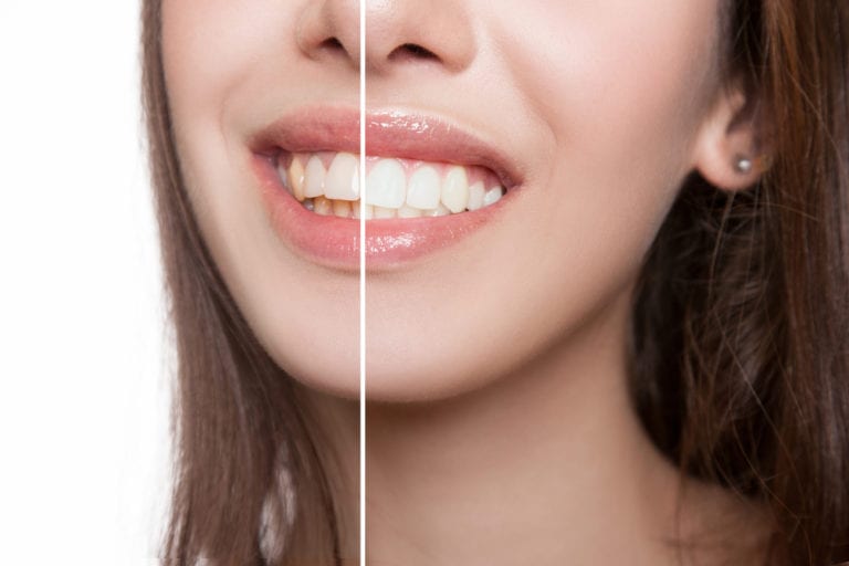 blanchiment dentaire boulogne issy saint cloud paris16