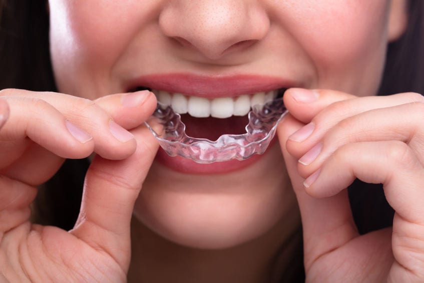 invisalign bologne billancourt 92